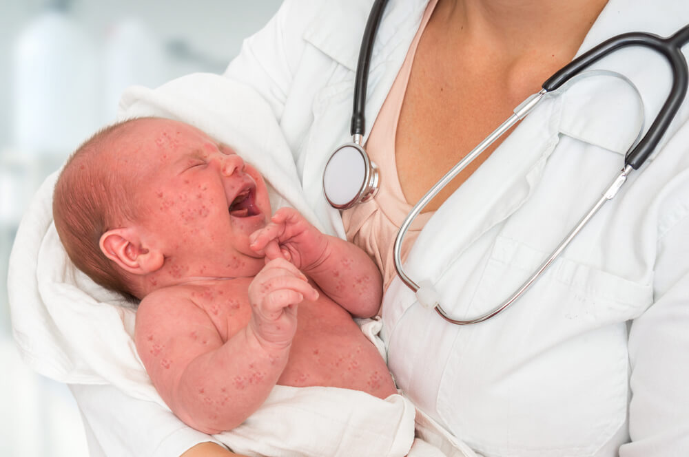 Las manchitas rojas en la piel del bebé tienen varias causas