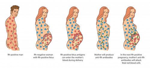 Infografía Rh de la madre, el padre y el bebé: incompatibilidad de Rh en el embarazo.