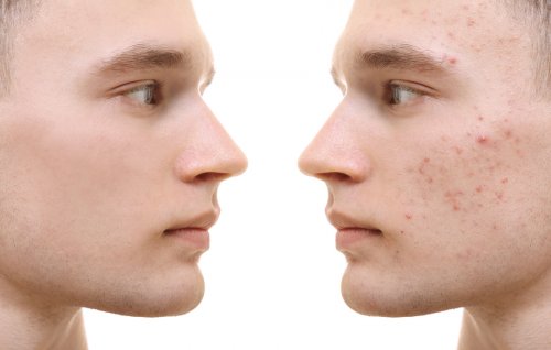 Existen varios tipos de acné y no todos tienen el mismo tratamiento.