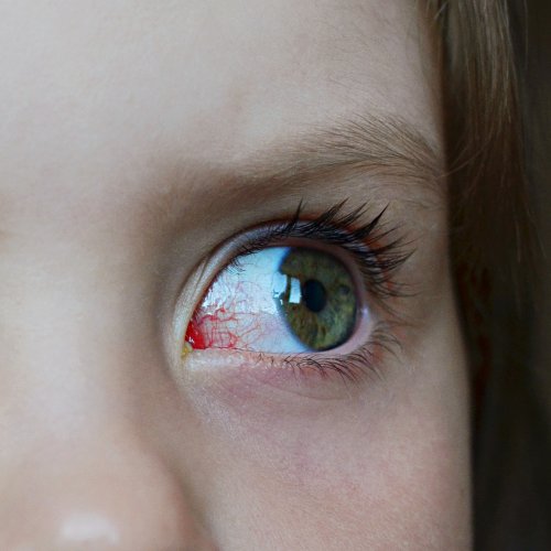 Niño con ojo rojo e inflamado como síntoma de un posible glaucoma infantil.