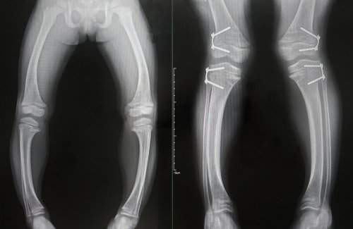 Radiografía de huesos con raquitismo.