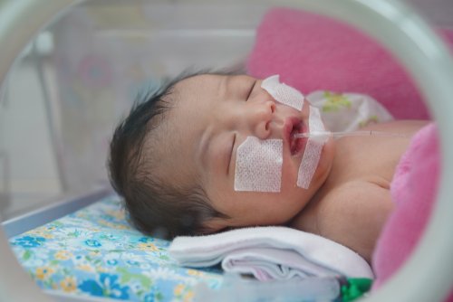 Bebé prematuro recién nacido con síndrome de dificultad respiratoria.