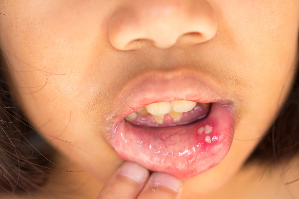 A girl with sores on the inside of her lower lip.