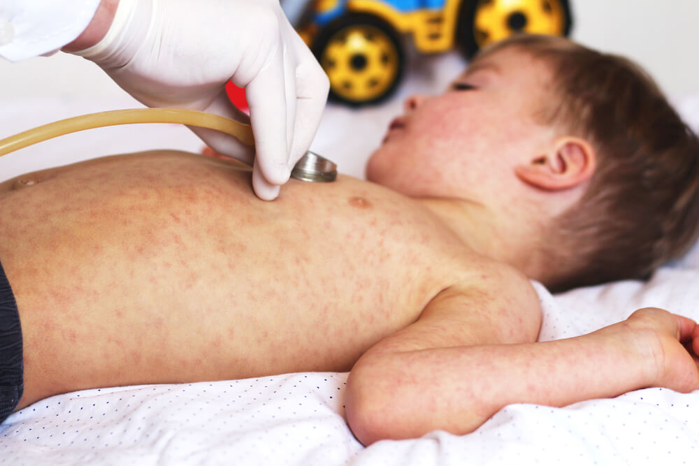 Niño en la cama con un brote de sarampión.