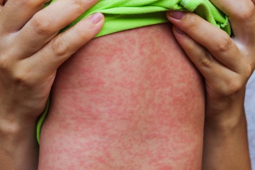 Brotes de sarampión y la importancia de la prevención