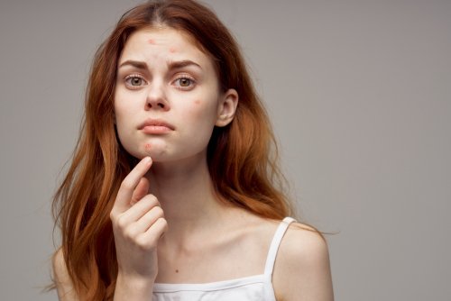 Adolescente sufriendo enormes cambios en su cuerpo, como la aparición de las temidas espinillas.
