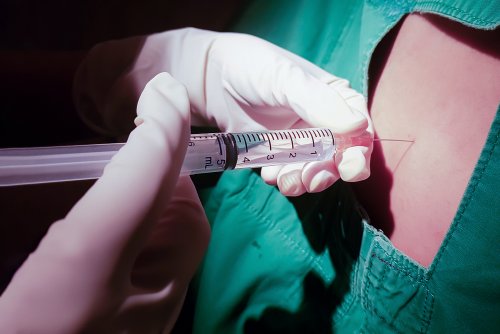 Analgesia epidural durante el parto para aliviar el dolor.