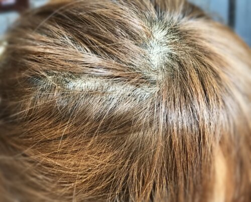 Cabeza de un niño con calvas debido a que se se arranca mechones de pelo por la tricotilomanía.