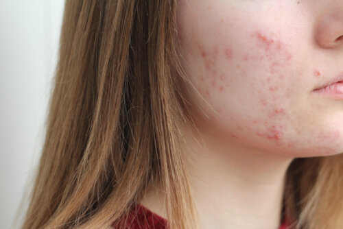 Jeune fille avec de l'acné.