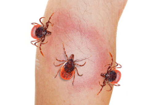 Eritema causado por la picadura de una garrapata, uno de los síntomas de la enfermedad de Lyme.