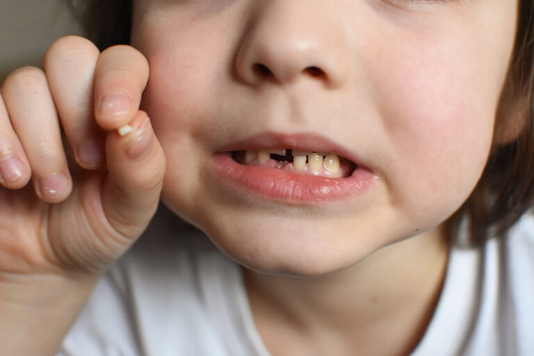 Golpes en los dientes de leche, ¿qué hacer?