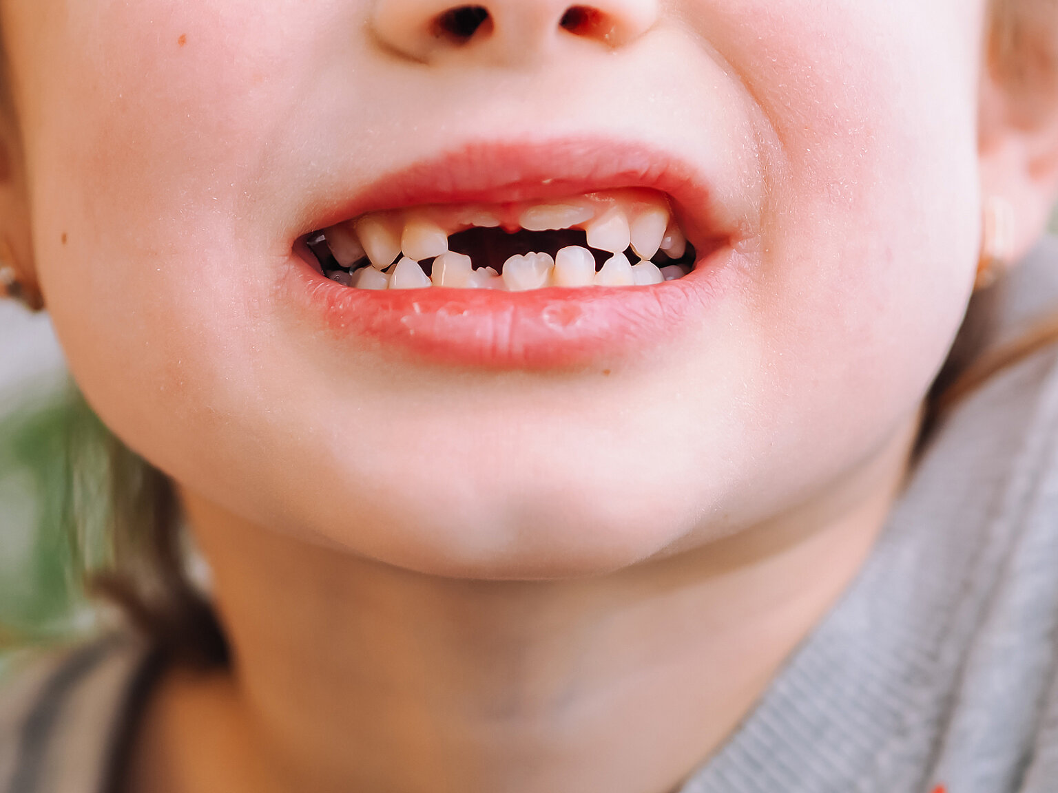 Golpes en los dientes de leche, ¿qué hacer? - Eres Mamá