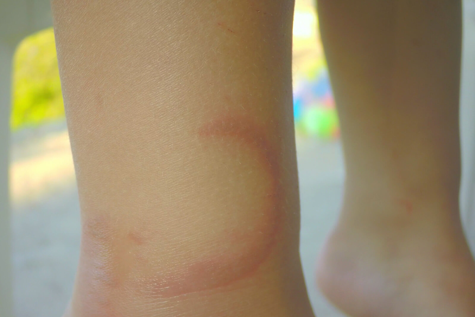 A child with a red mark on his leg.