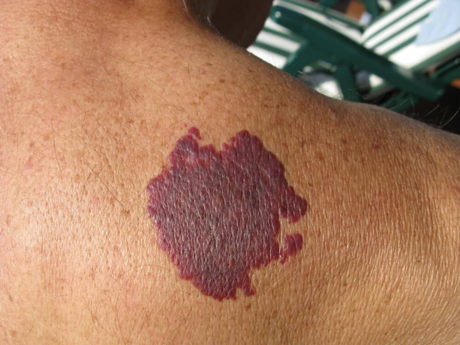 Purple Spots Under Skin