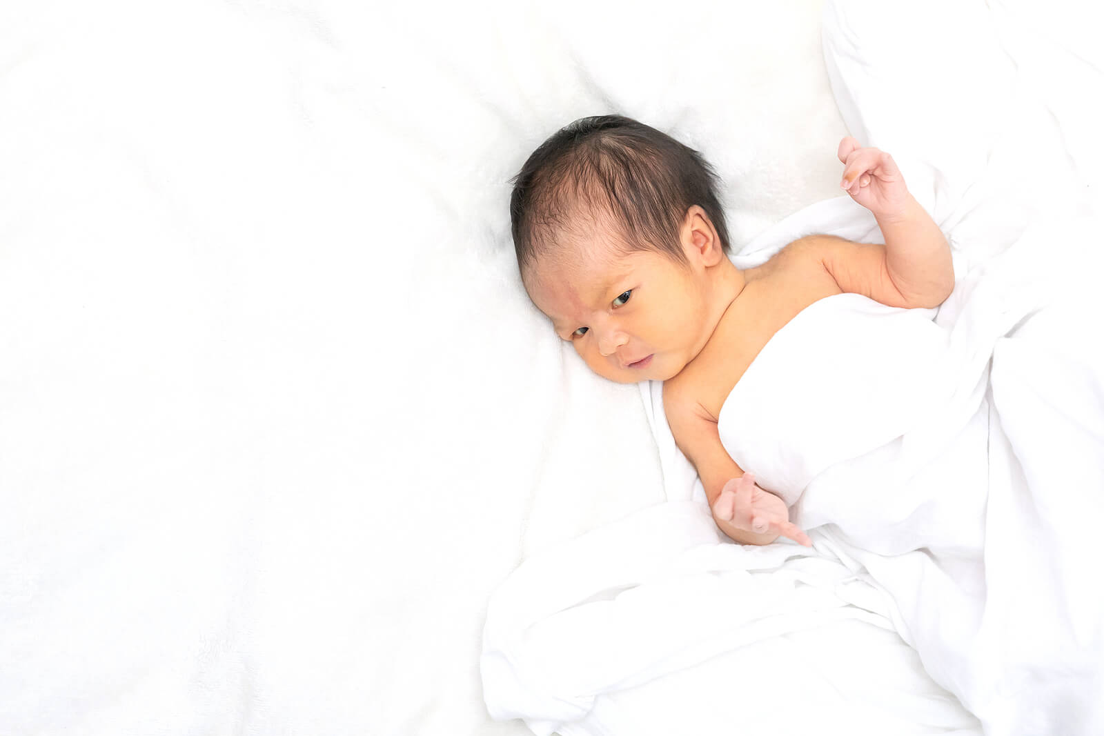 Bebé recién nacido con síndrome de Sanfilippo.