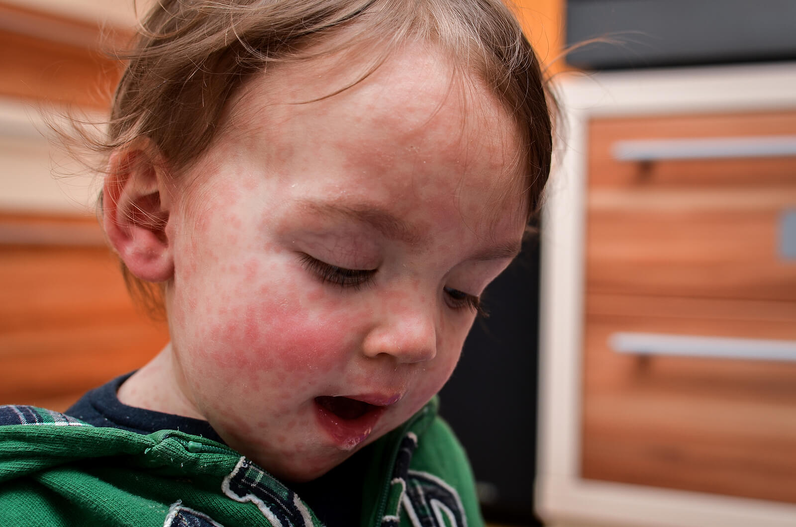 Niño con la cara llena de roncha porque sufre alergia a la proteína de leche de vaca.