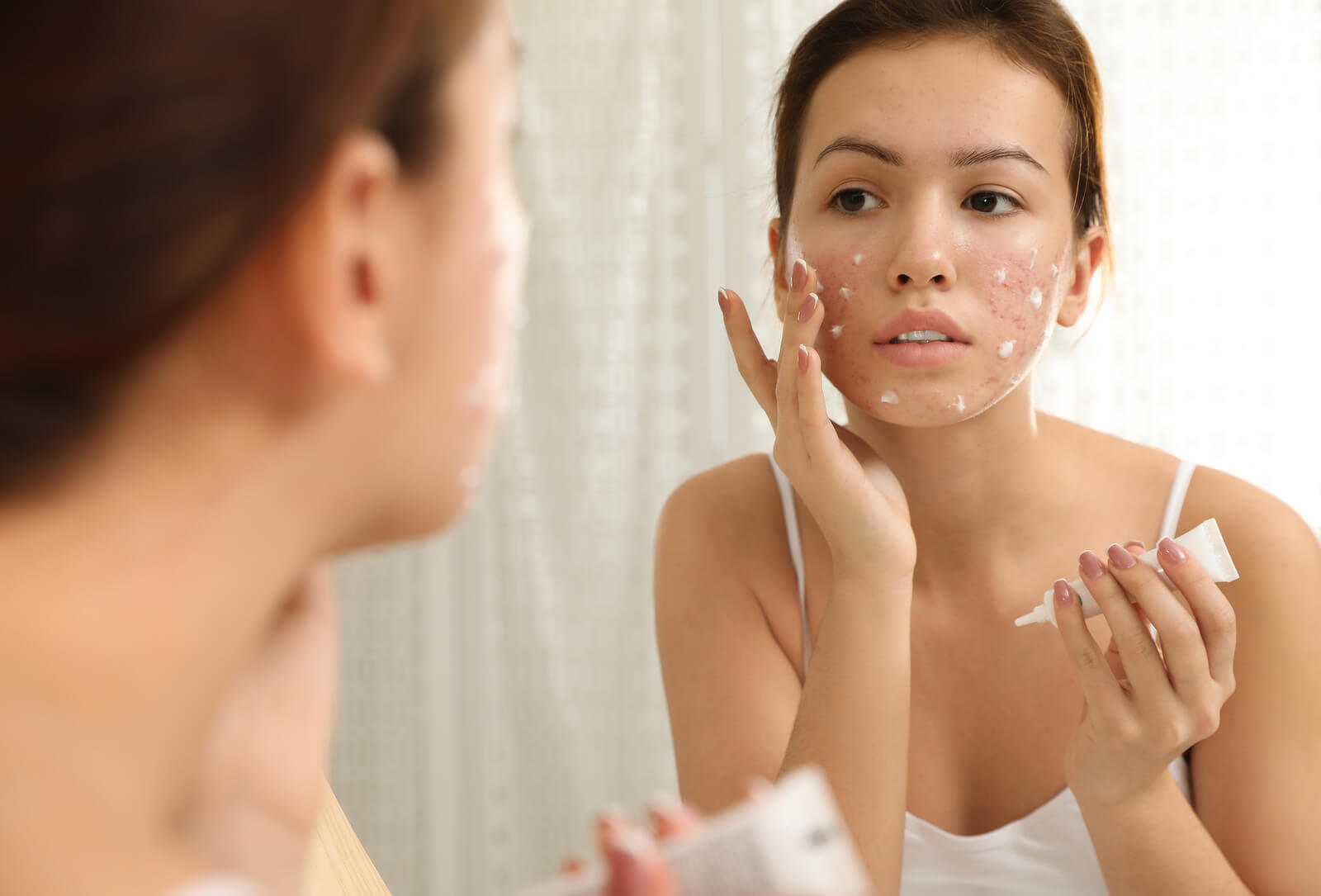 A teen girl putting acne cream on her skin.