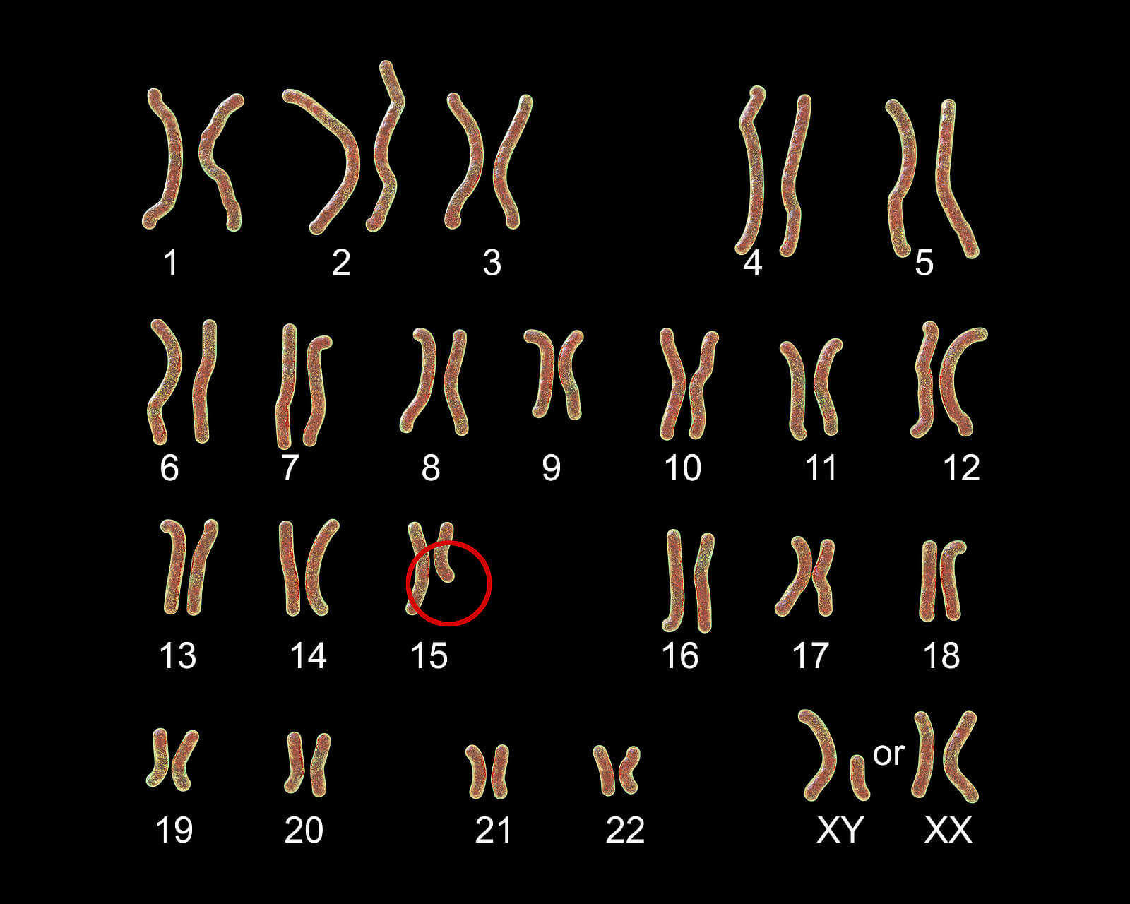 Cromosomas síndrome Prader Willi.