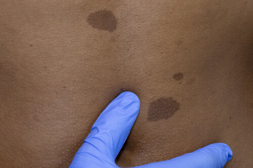 Neurofibromatosis tipo 1 en niños: síntomas, causas y tratamiento