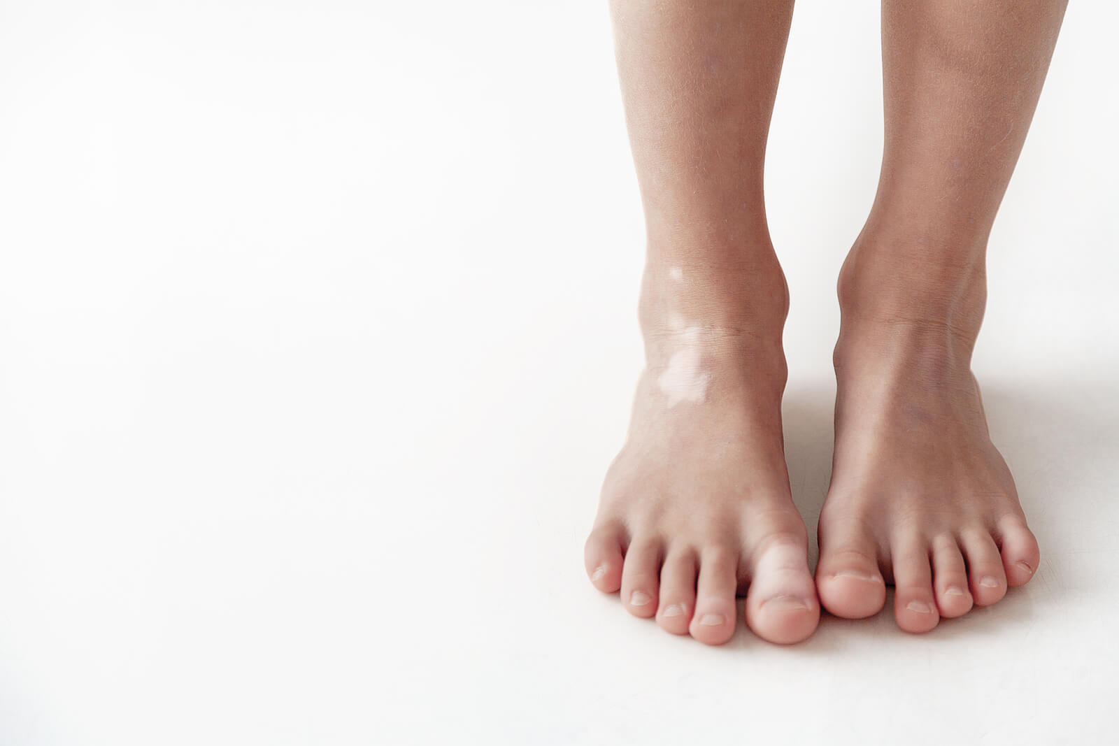 A child with white spots on his foot.
