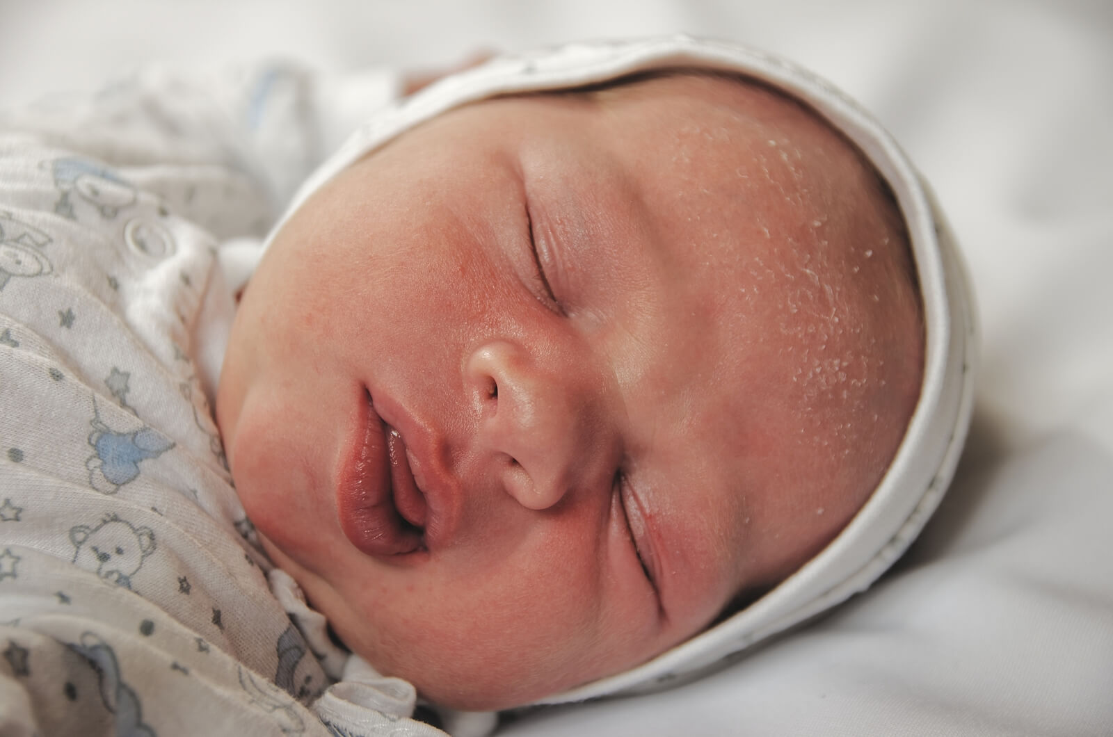 Bebé recién nacido con costra láctea o dermatitis seborreica infantil.