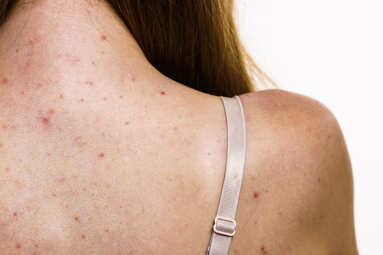 Adolescente con acné en la espalda, una de las dermatosis del adolescente más comunes.