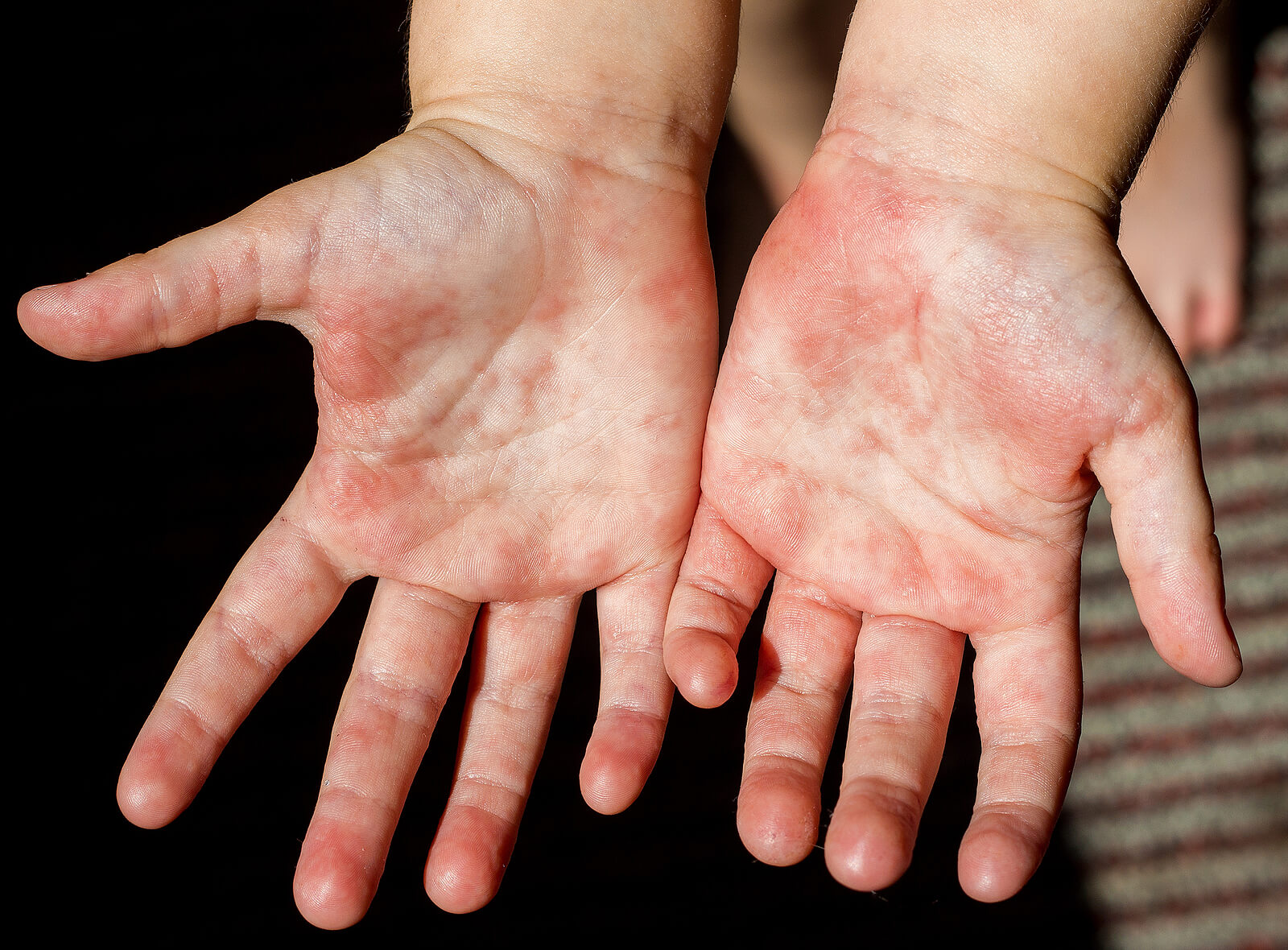 Las 10 enfermedades de la piel más comunes en niños