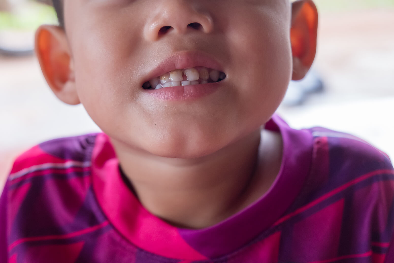 Niño con caries de la infancia temprana.