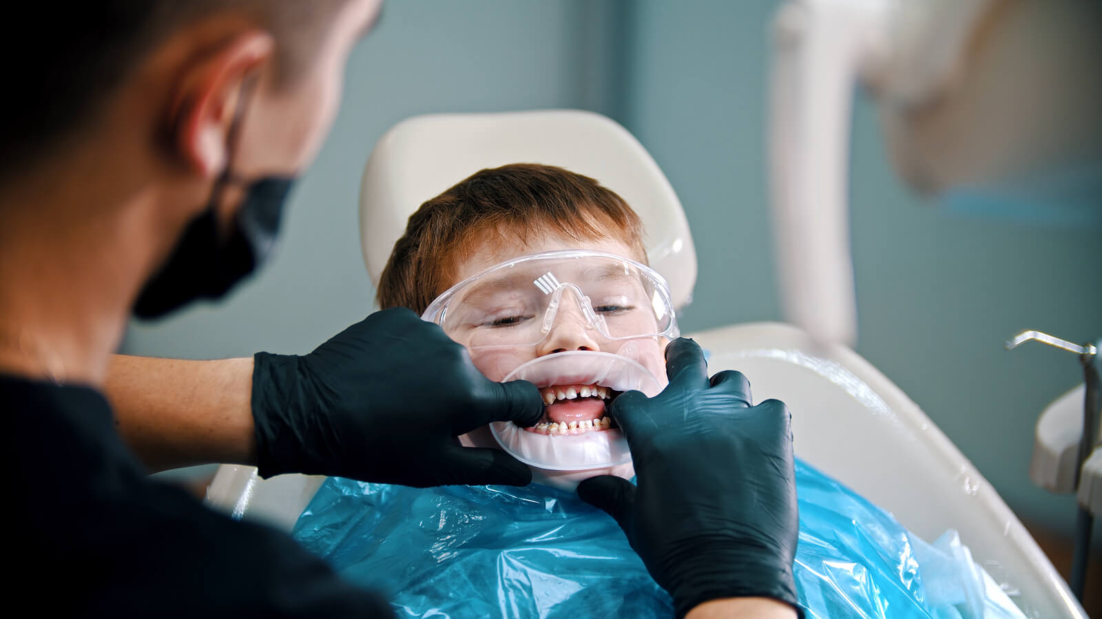 Niño en el dentista al que le están haciendo un sellado de dientes.
