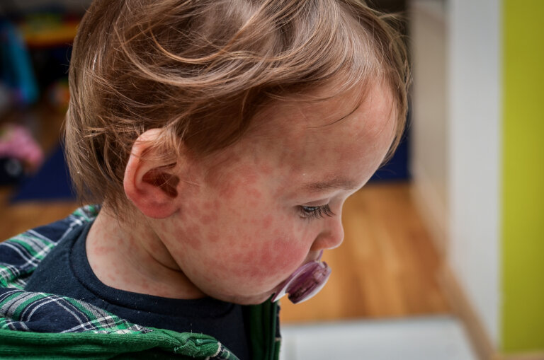 Tipos de dermatitis en niños