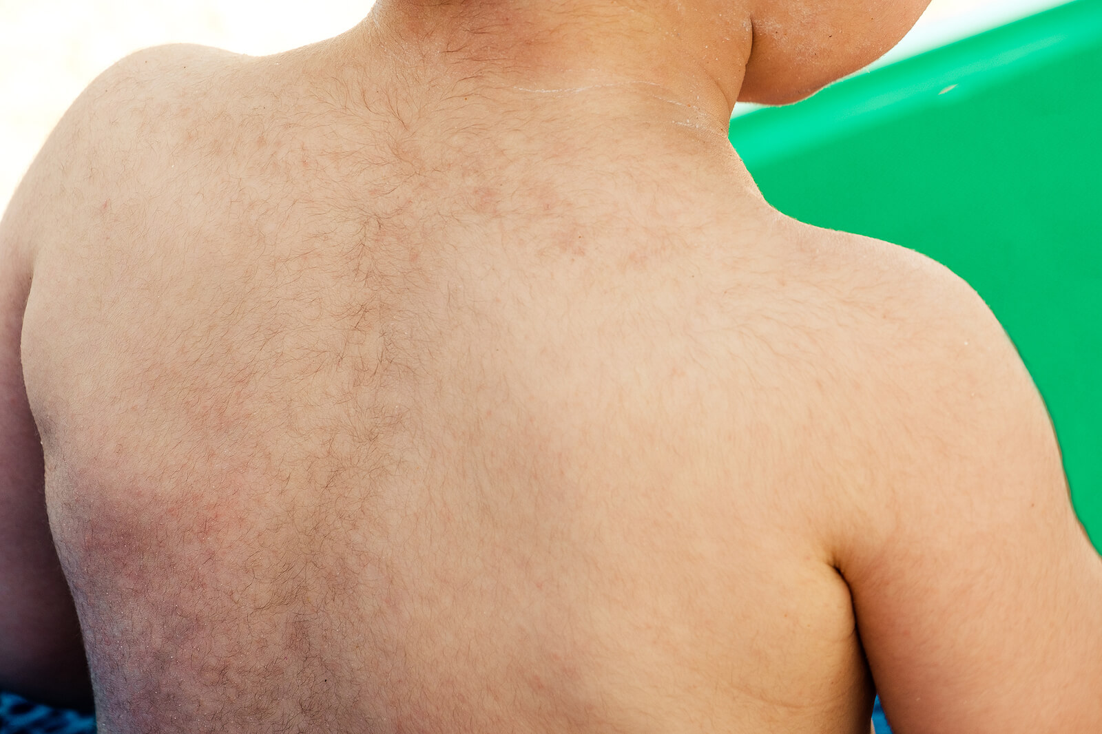 Niño con hipertricosis.