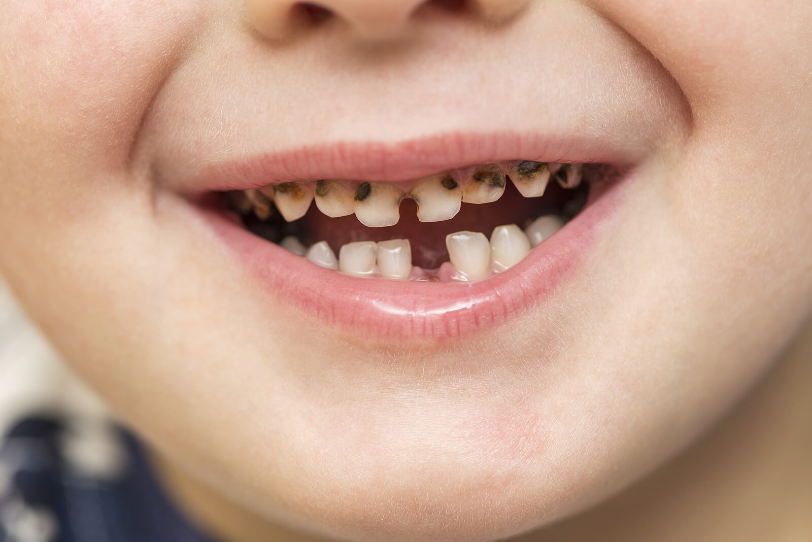 Niño con la boca llena de caries de la infancia temprana.