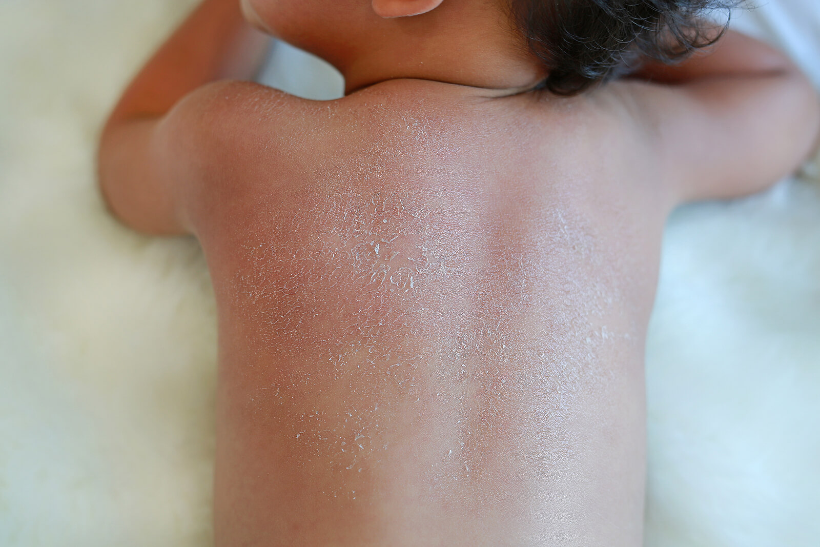 La piel seca en los niños