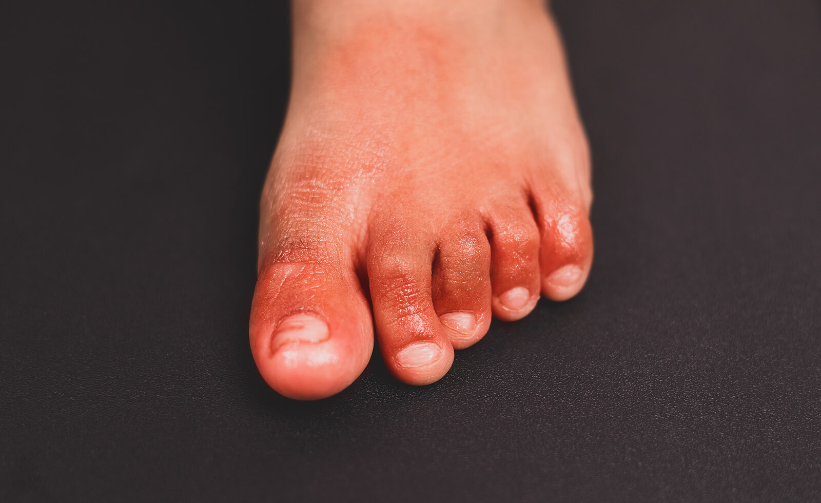A child's foot with chilblains from the cold.