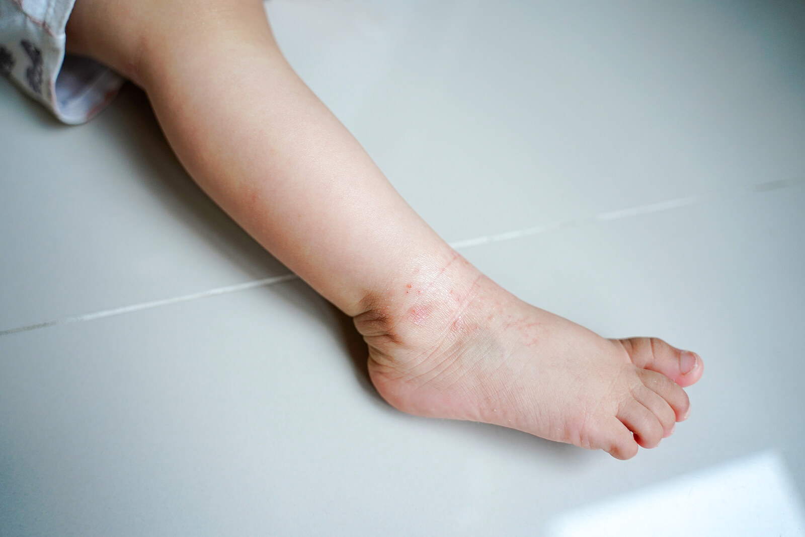 Pierna de un niños con dermatitis atópica, una de las enfermedades de la piel más comunes en niños.