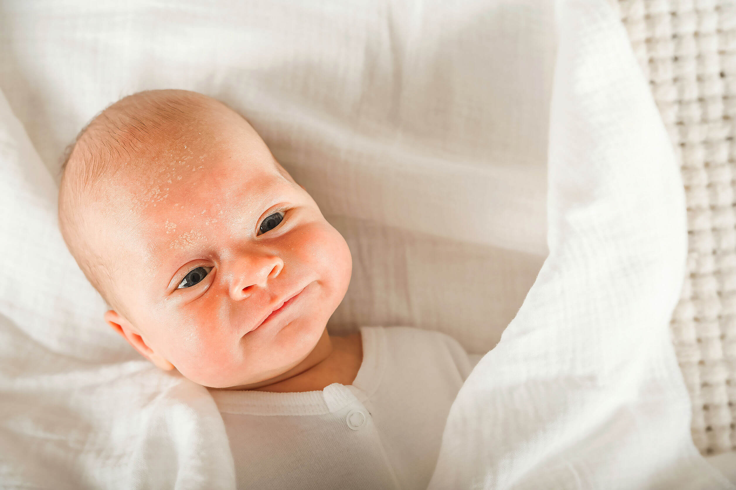 Bébé atteint de dermatite séborrhéique infantile.