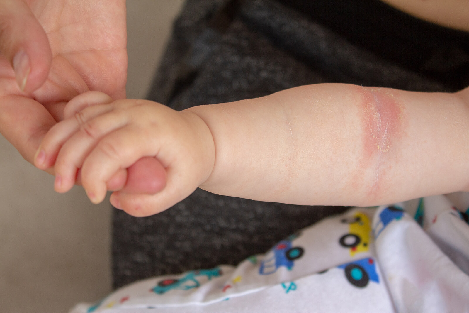 En bebis med hudutslag på armen.