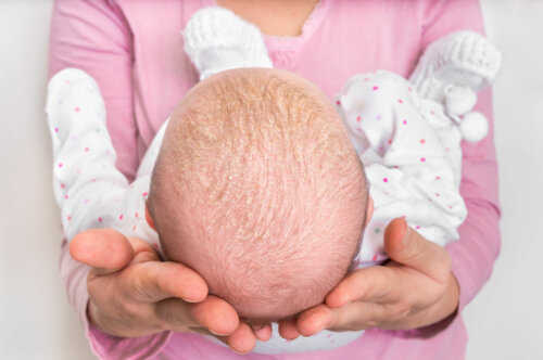 Dermatitis seborreica infantil