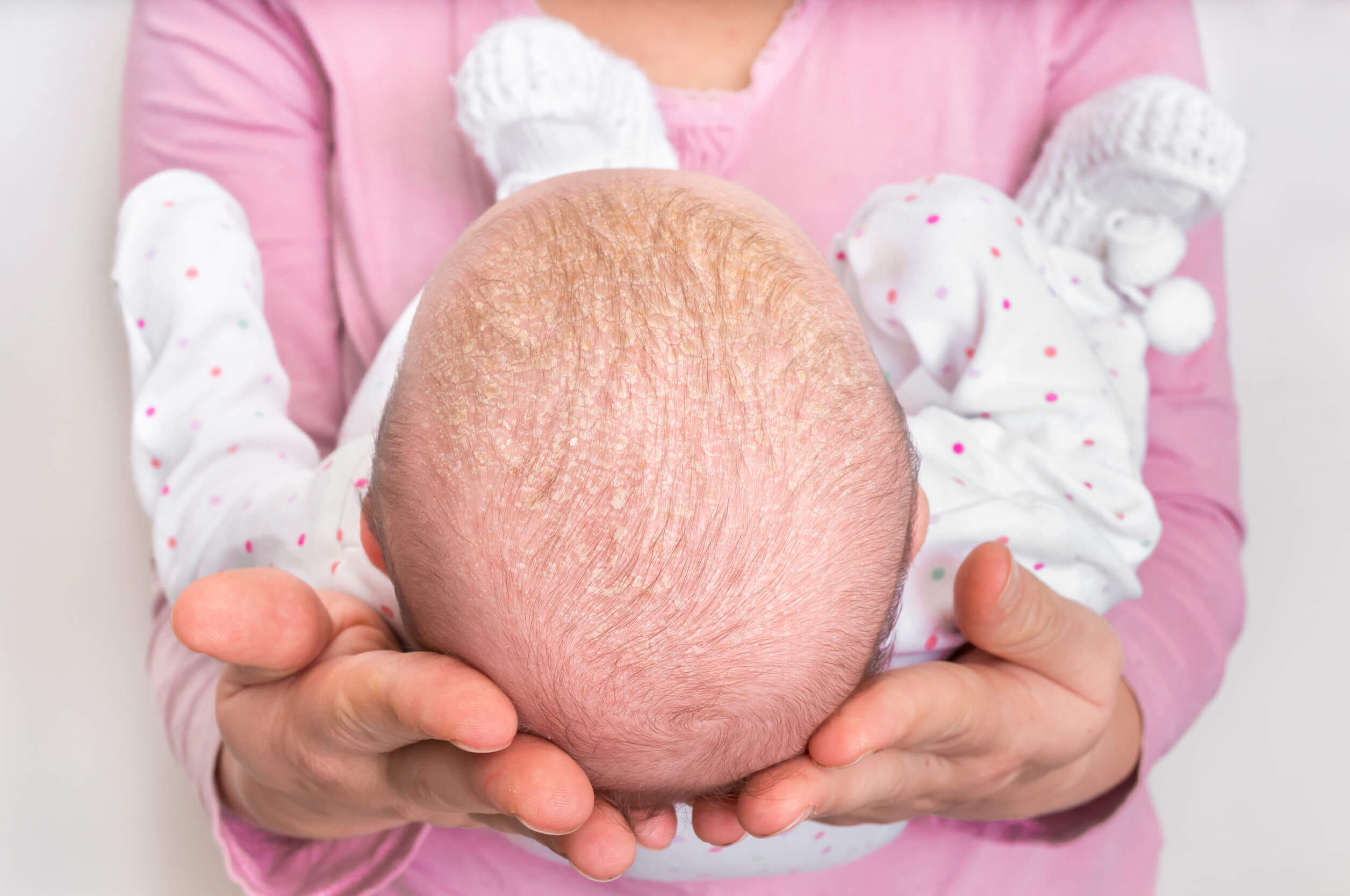 Dermatitis seborreica infantil y costra láctea - Eres Mamá Enfermedades  infantiles
