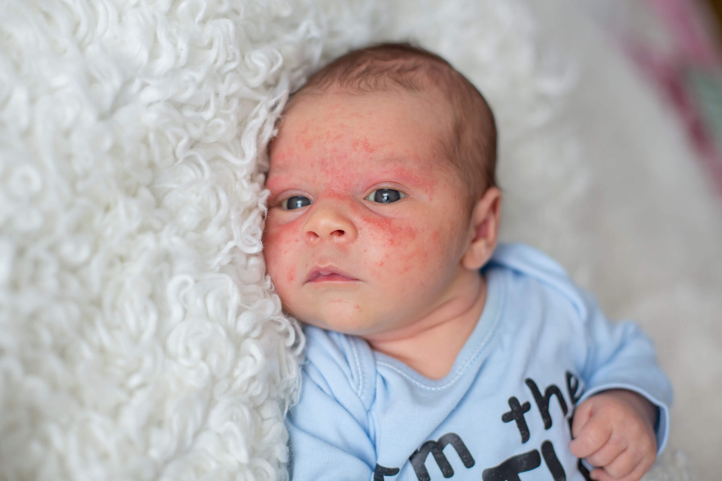 A baby with a rash on his face.