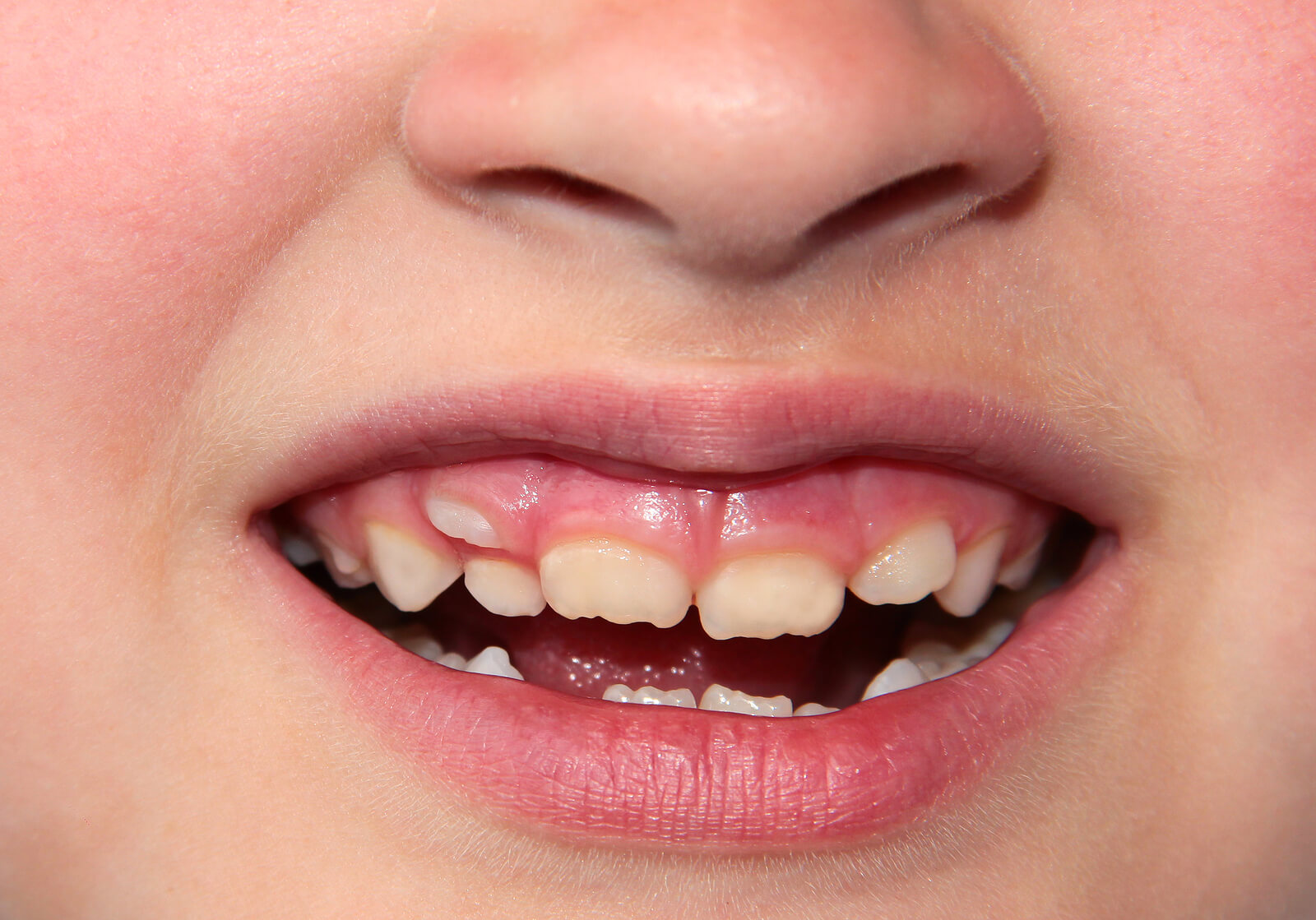 Boca de uma criança com apinhamento dentário.
