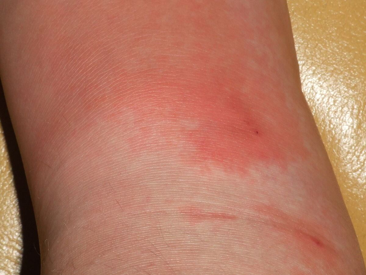 A reddened area on a child's skin.