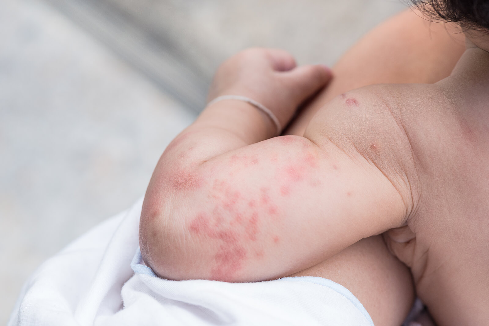 Bras d'un enfant avec de l'urticaire.