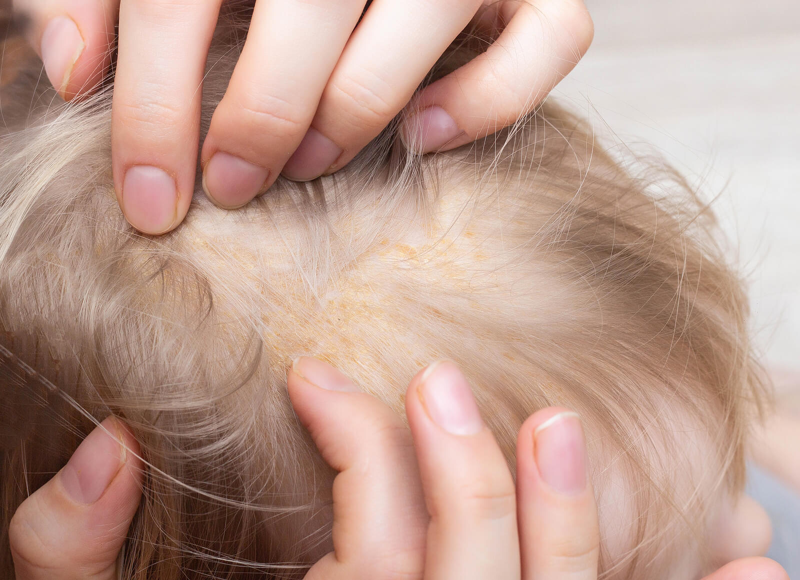 Cabeza de un niño con dermatitis seborreica.
