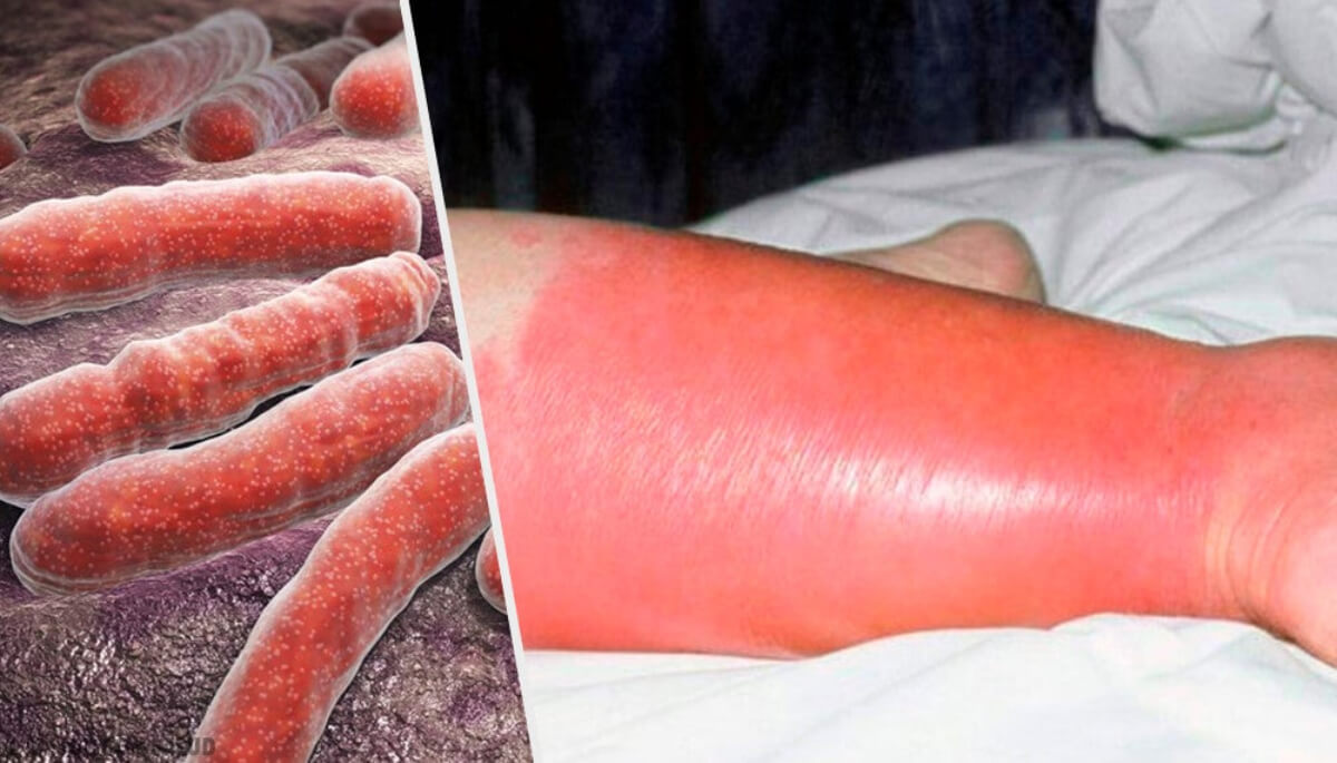 La erisipela en la infancia