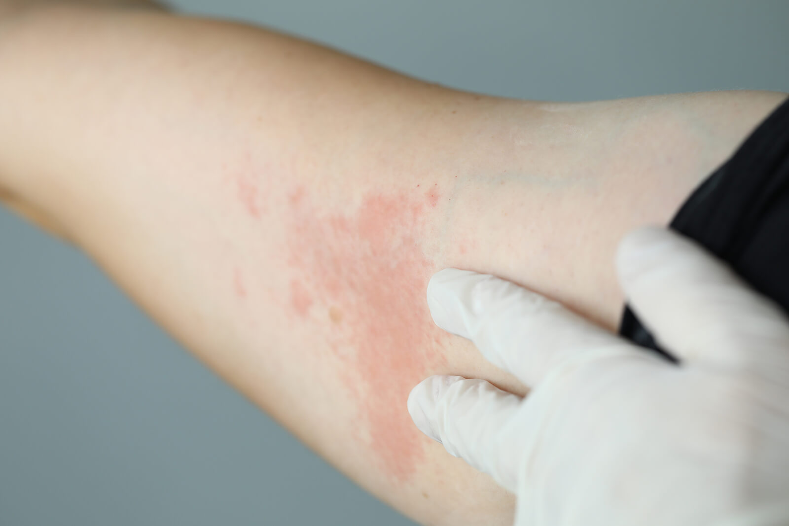 Las cremas para las infecciones de la piel