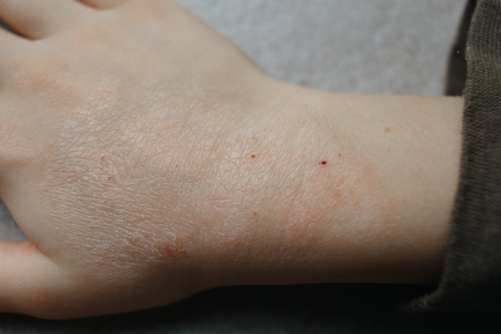 Micosis cutáneas en los niños