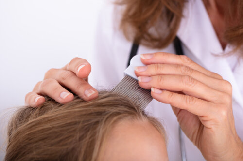 Pediculosis (piojos): qué debes saber