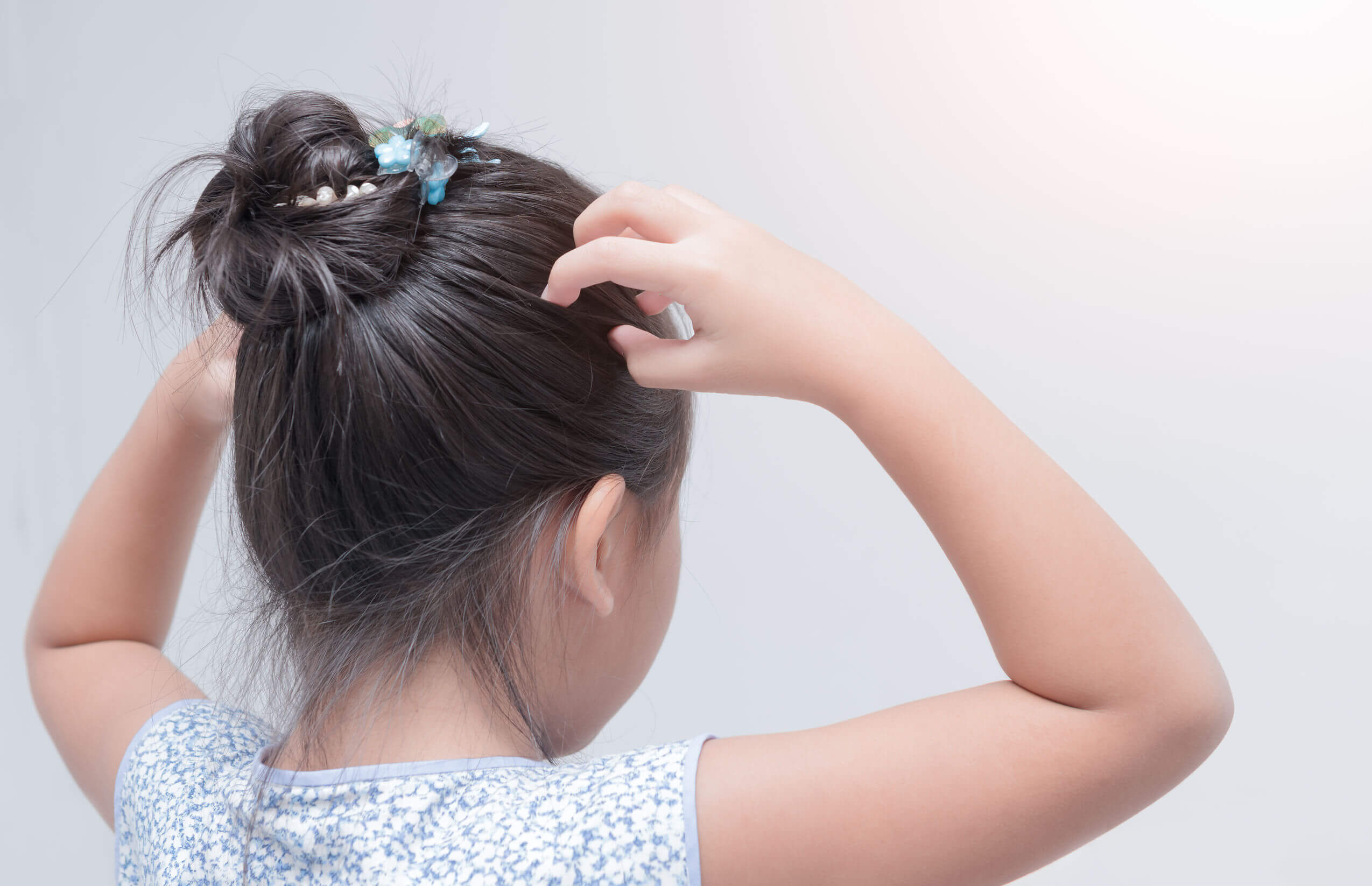 Alopecia en niños: síntomas, causas y tratamiento