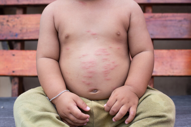 Niños con alergias en la piel: síntomas y recomendaciones